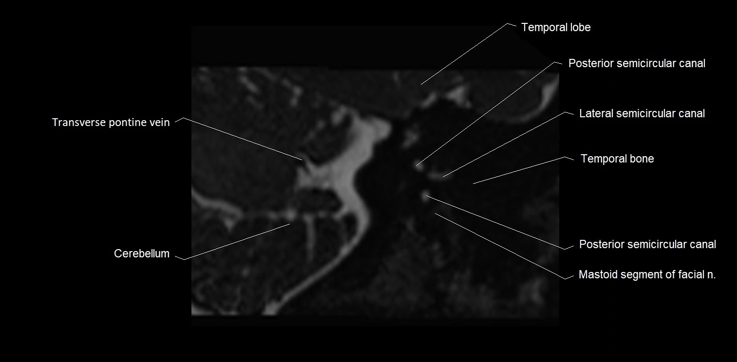 MRI Internal auditory meatus (IAM) coronal cross sectional labelled anatomy image 29.webp